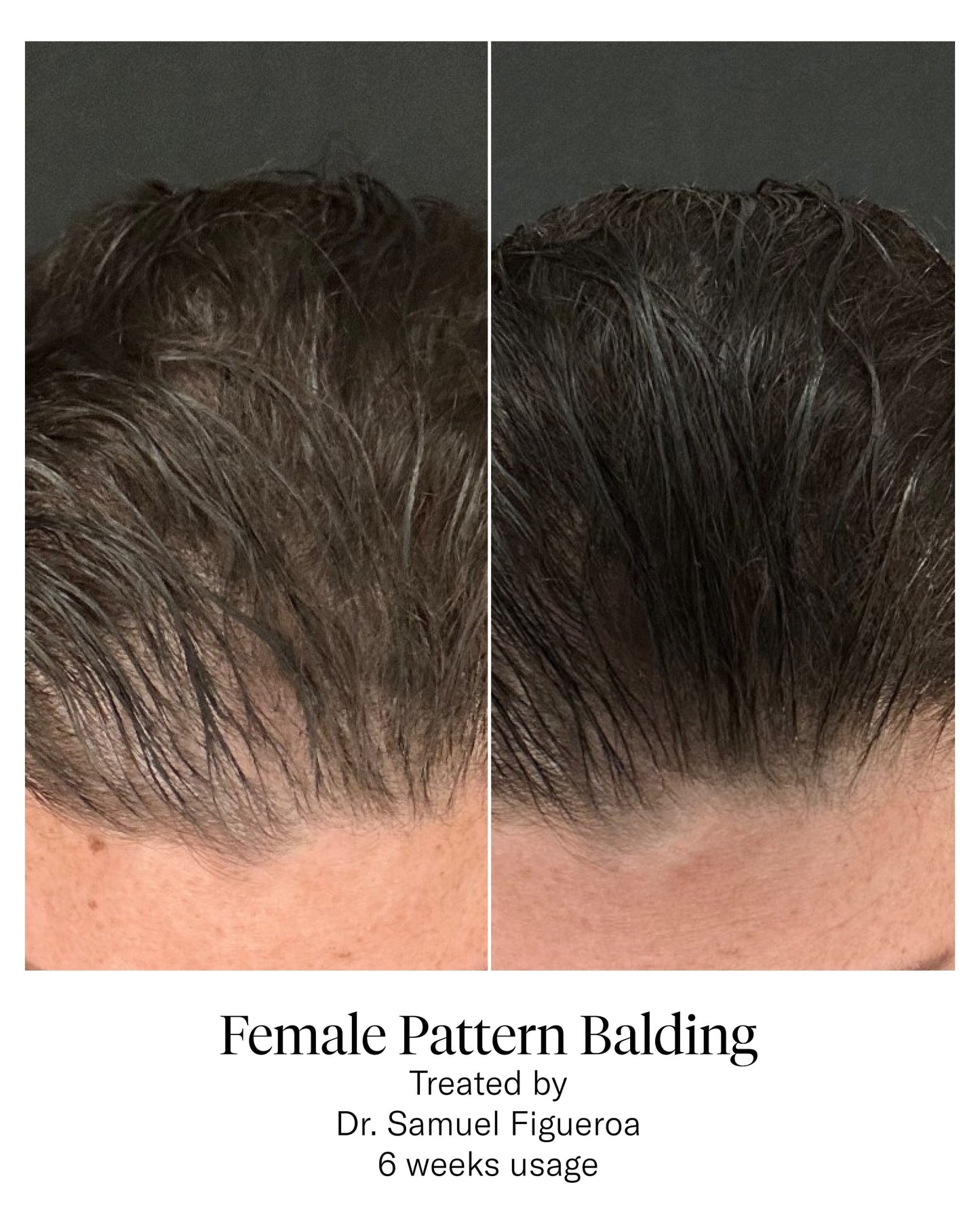 Advanced Hair System